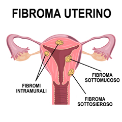 Fibroma utero