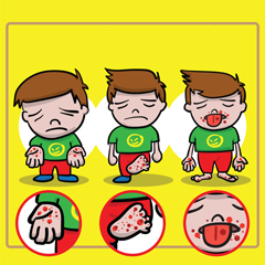 Malattia mani-piedi-bocca