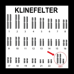 Sindrome di Klinefelter