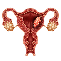 Tumore dell'utero