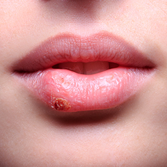 Herpes Simplex delle labbra: una febbre che ricorre periodicamente