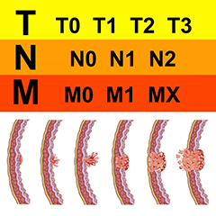 Stadiazione dei tumori Stadiazione dei tumori
